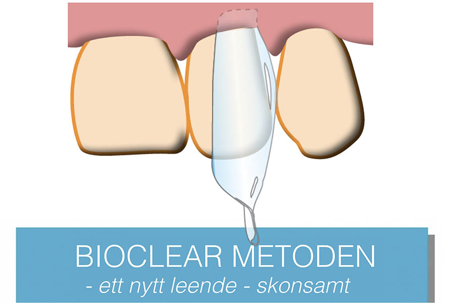 Bioclear metoden för tandkorrigeringar utan borrning